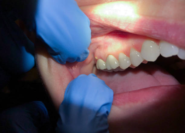 Best Emergency Dental Care for Broken or Chipped Teeth in Snohomish, WA